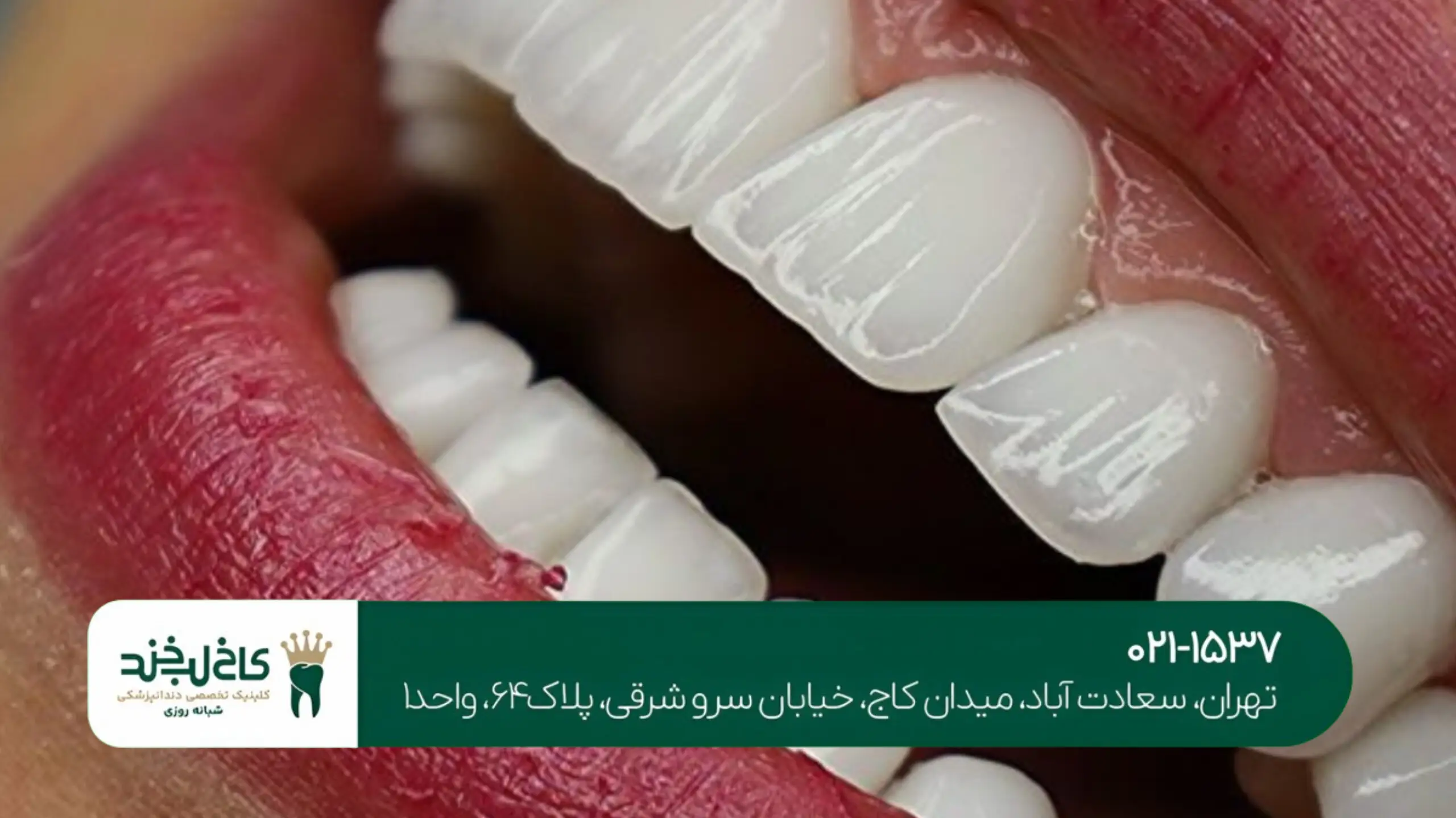 تفاوت لمینت و کامپوزیت