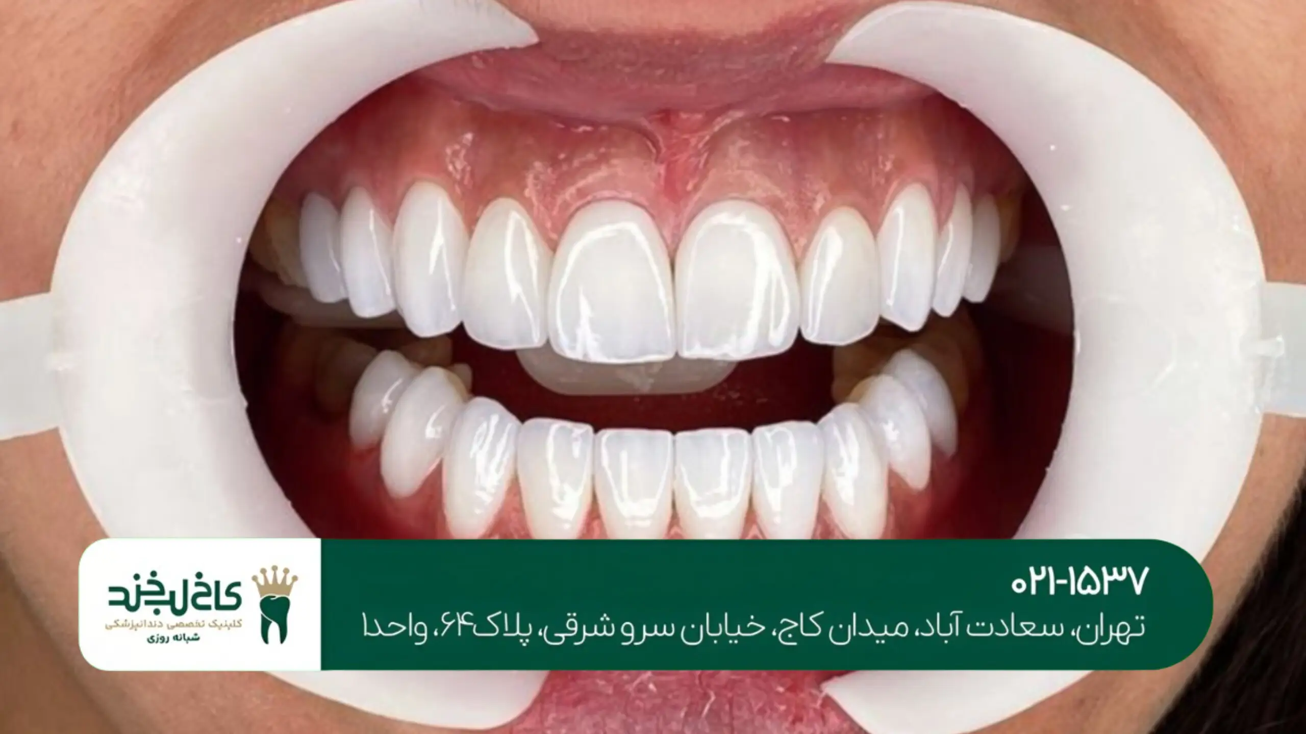 تفاوت لمینت و کامپوزیت