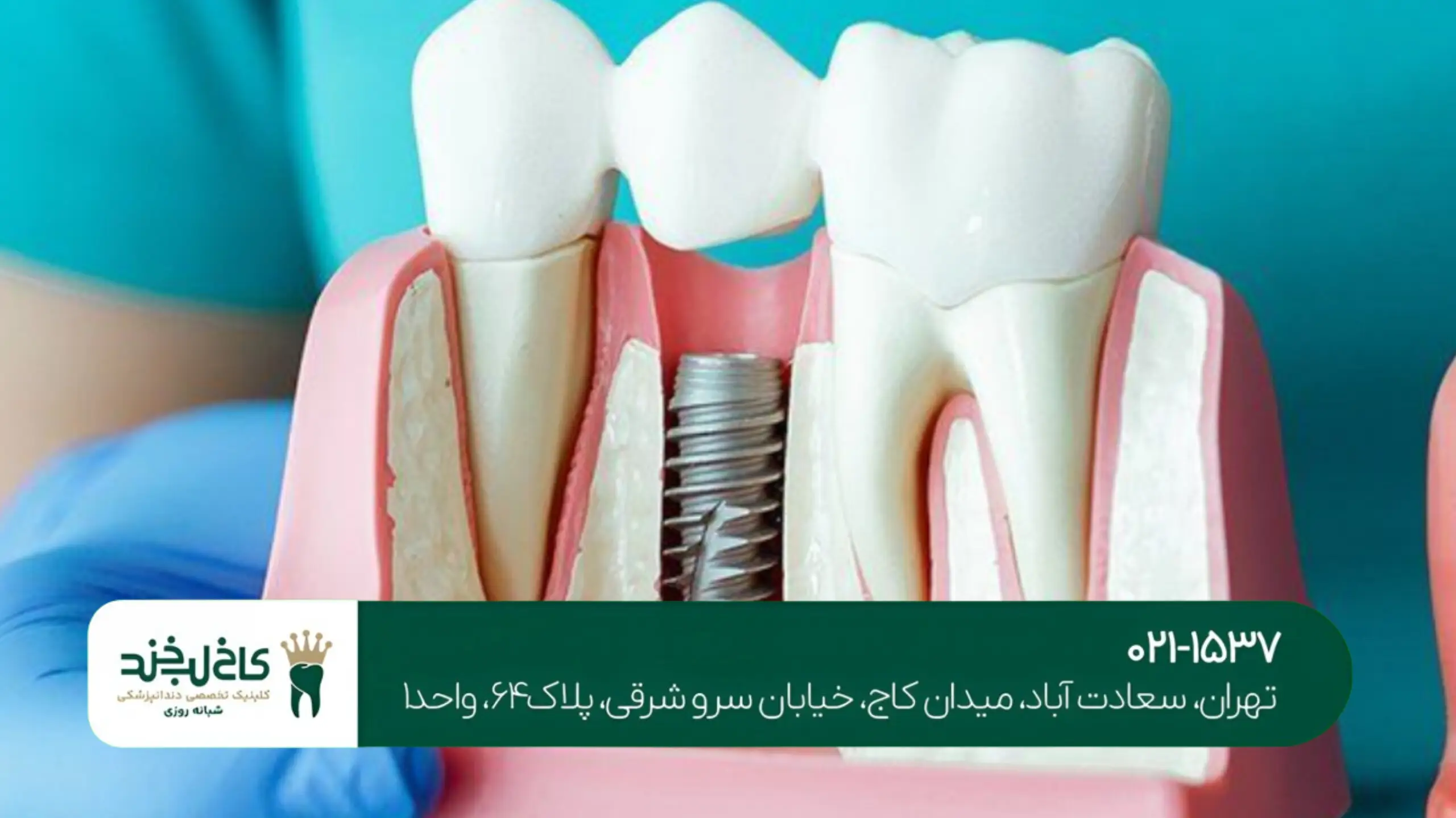 مراحل ایمپلنت دندان