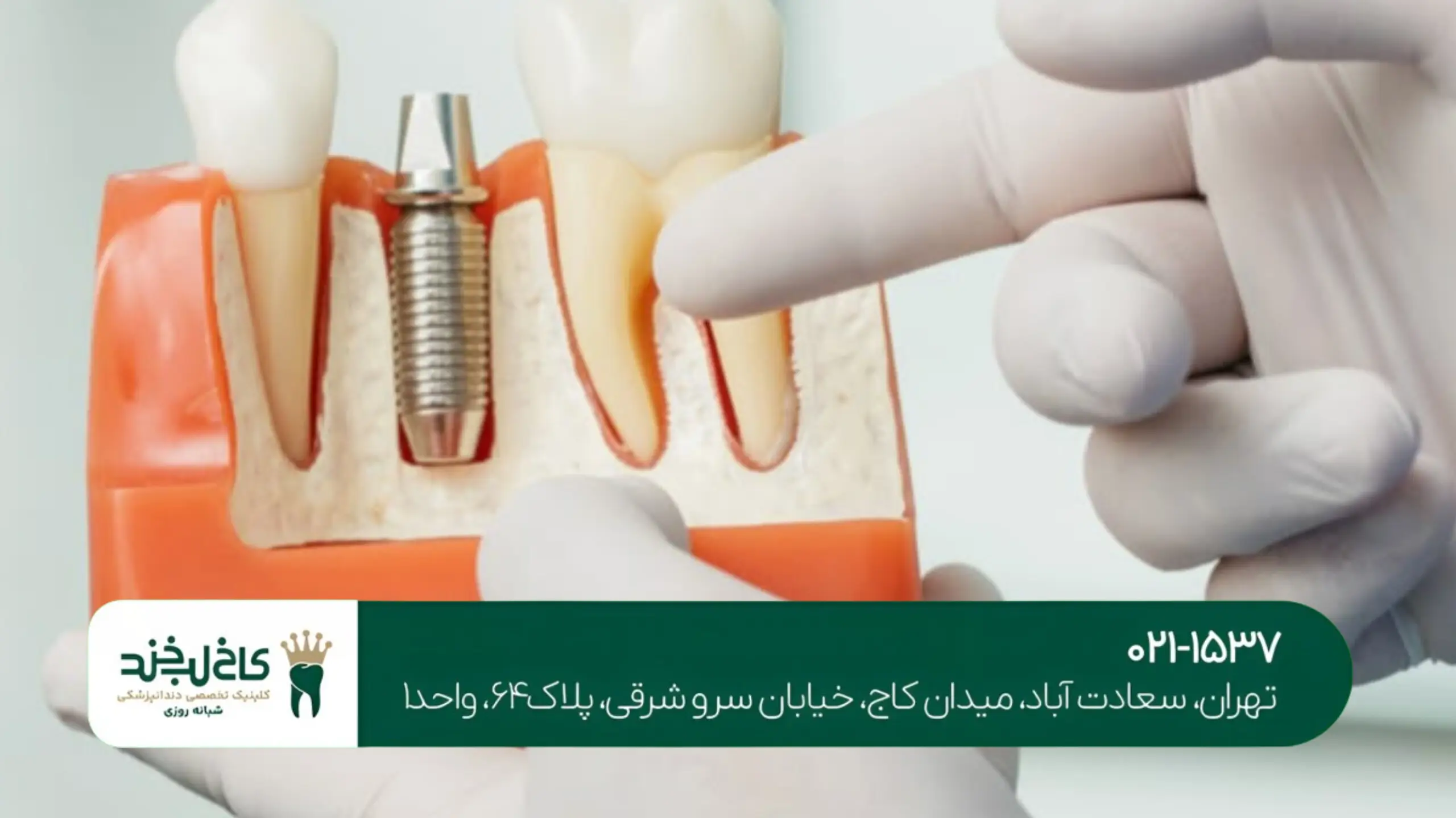 مراحل ایمپلنت دندان