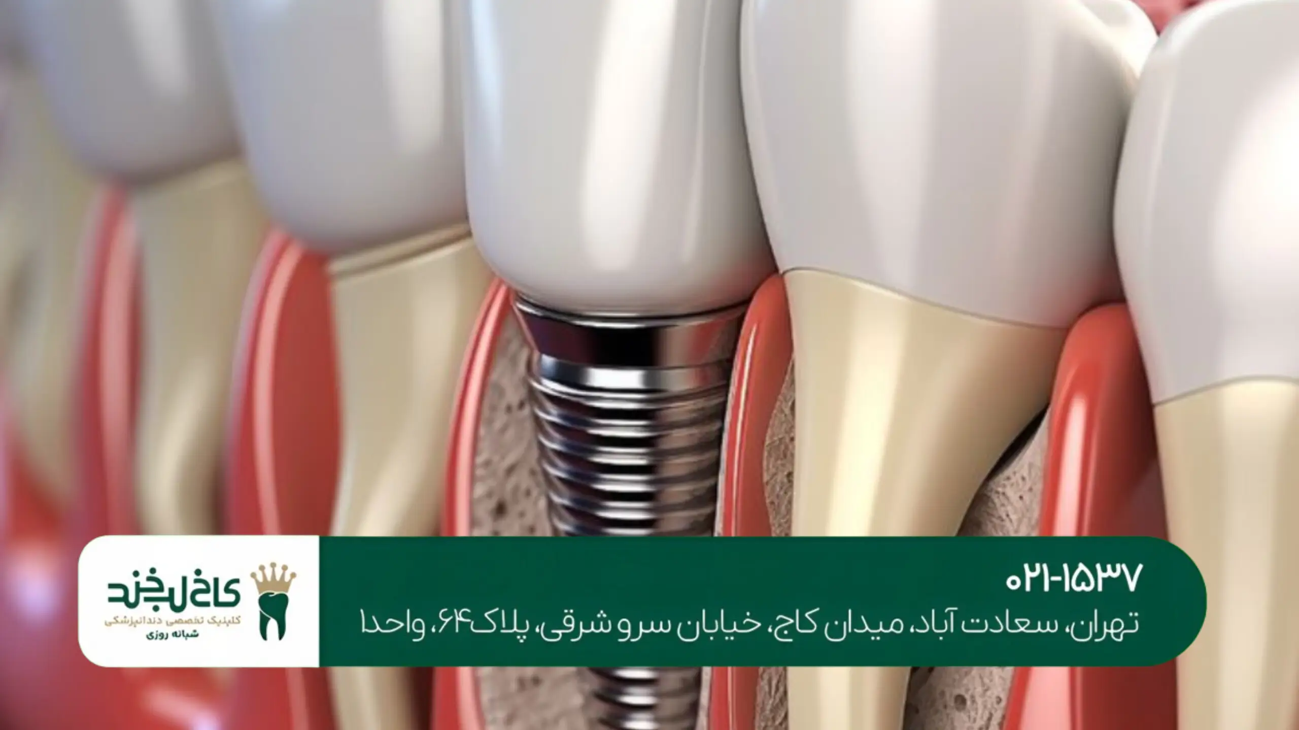 مراحل ایمپلنت دندان