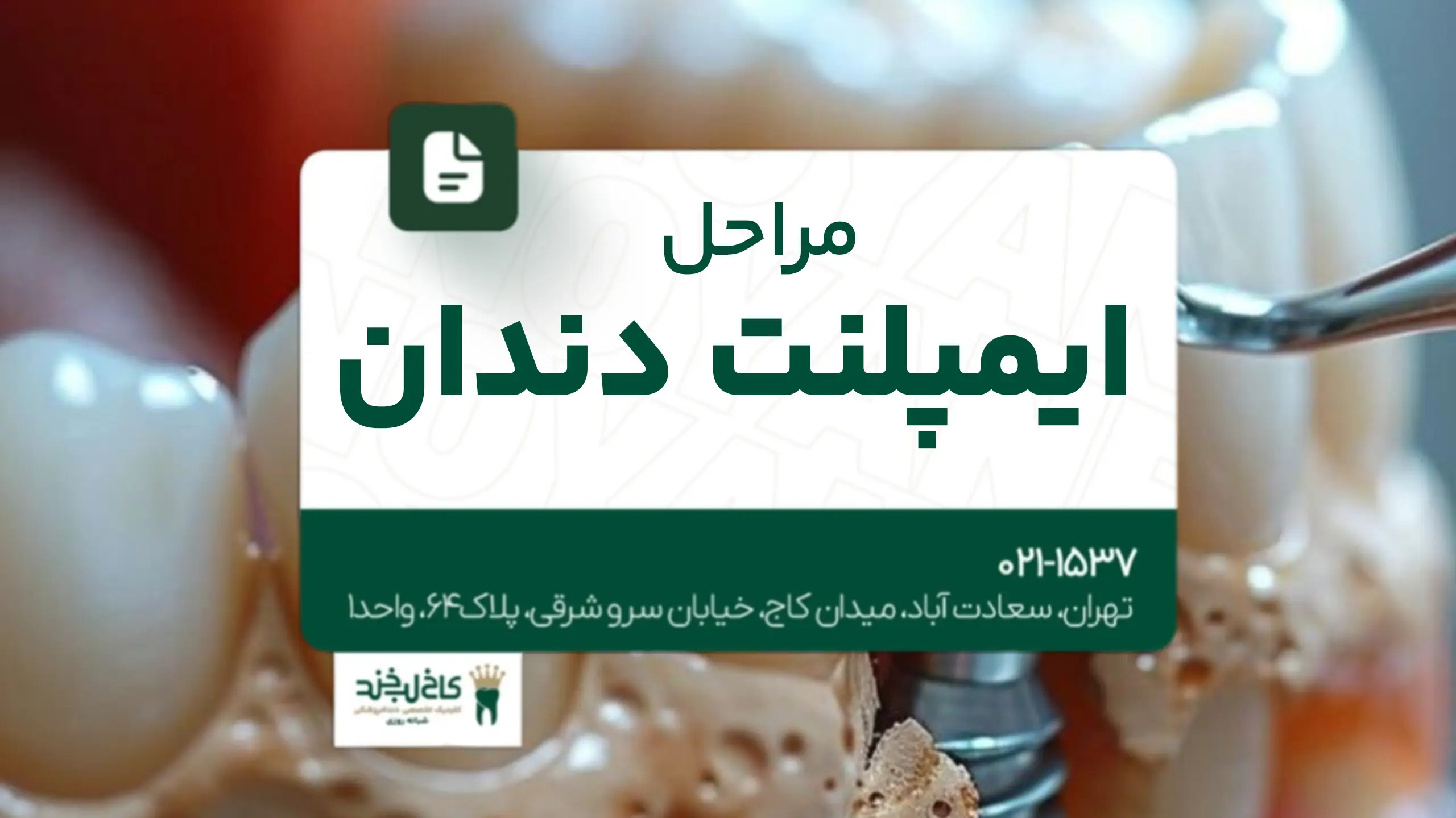 مراحل ایمپلنت دندان