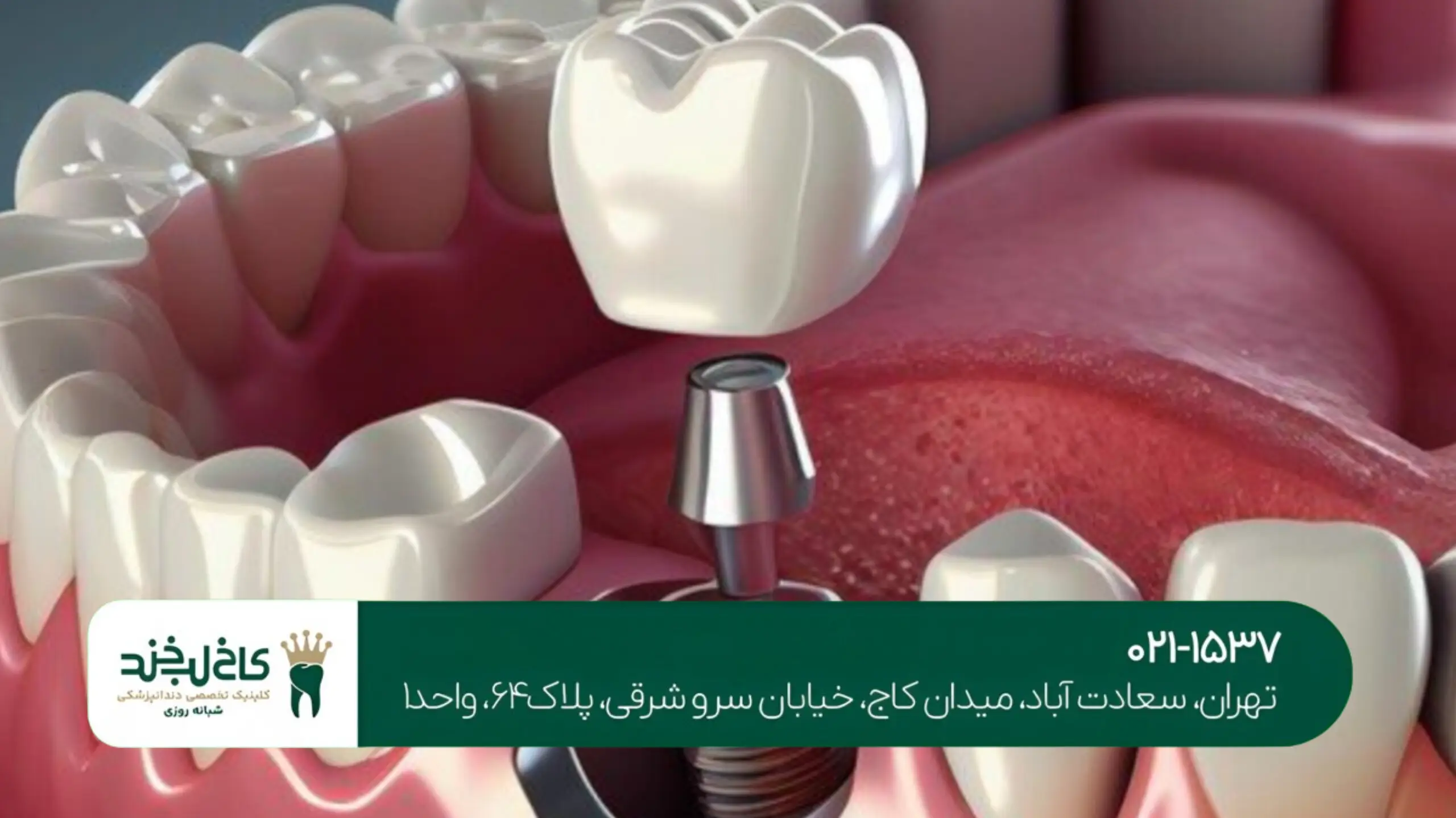 متخصص ایمپلنت و زیبایی