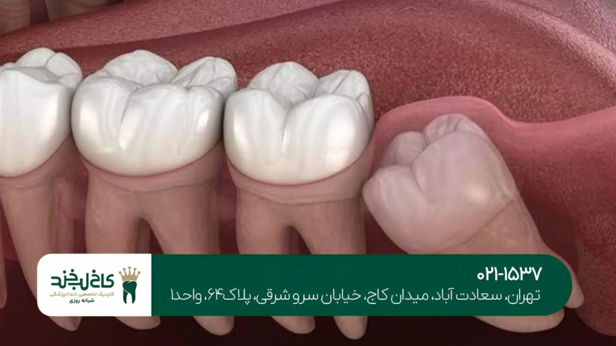 درمان تخصصی شکستگی دندان