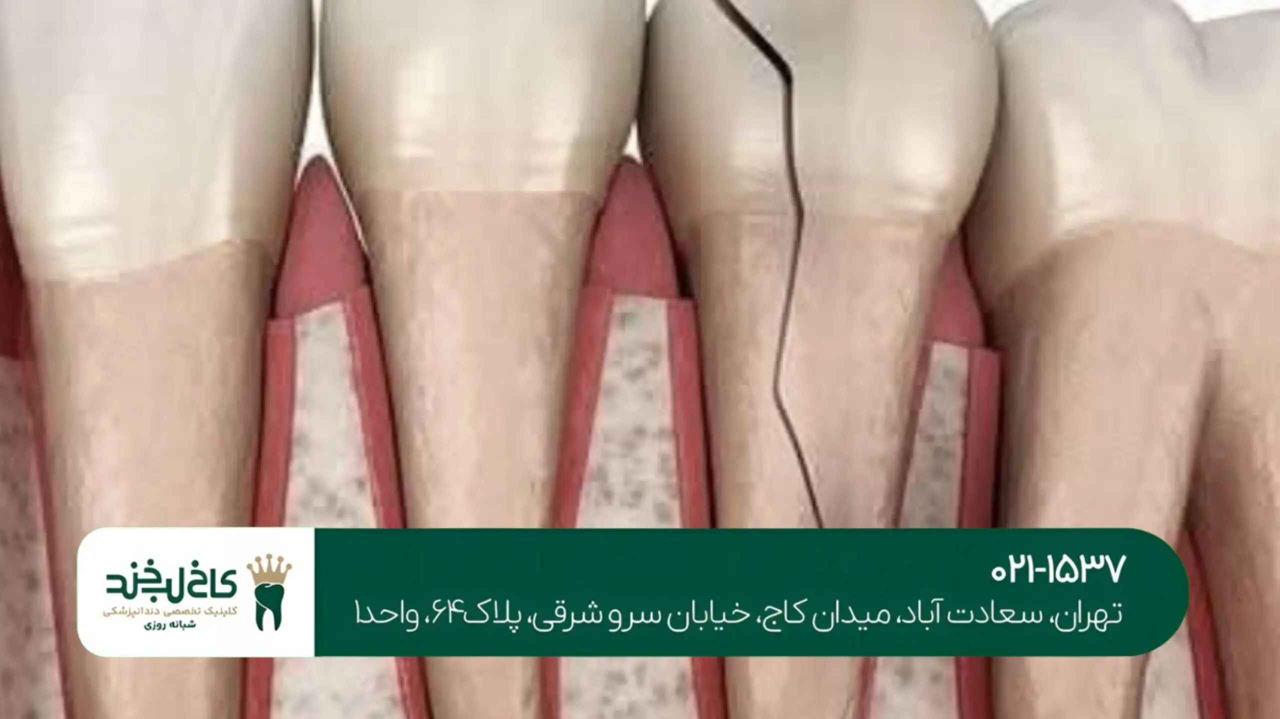 درمان تخصصی شکستگی دندان