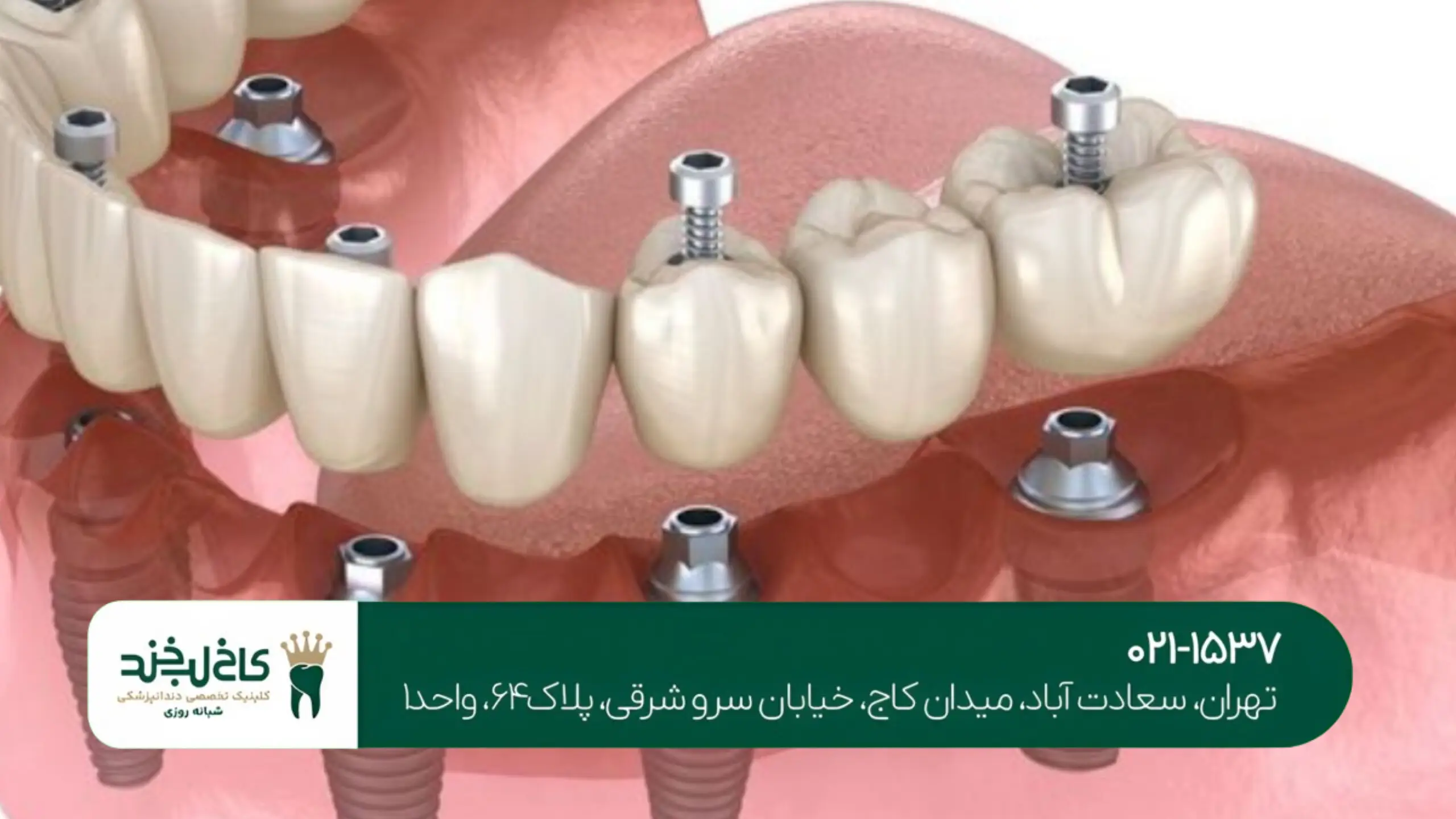 ایمپلنت اقساطی