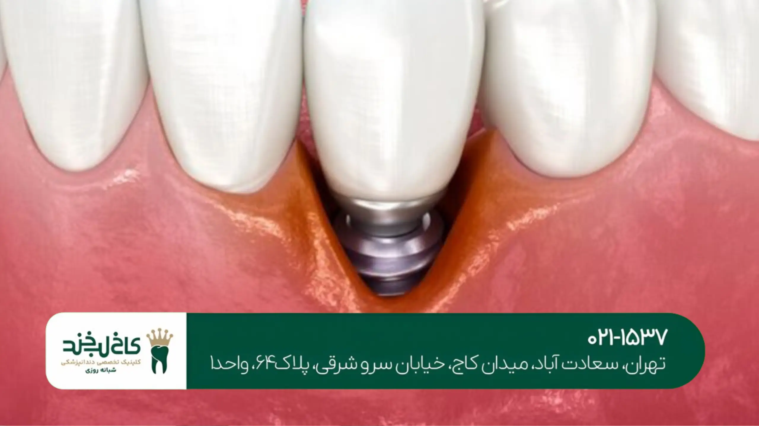 ایمپلنت اقساطی