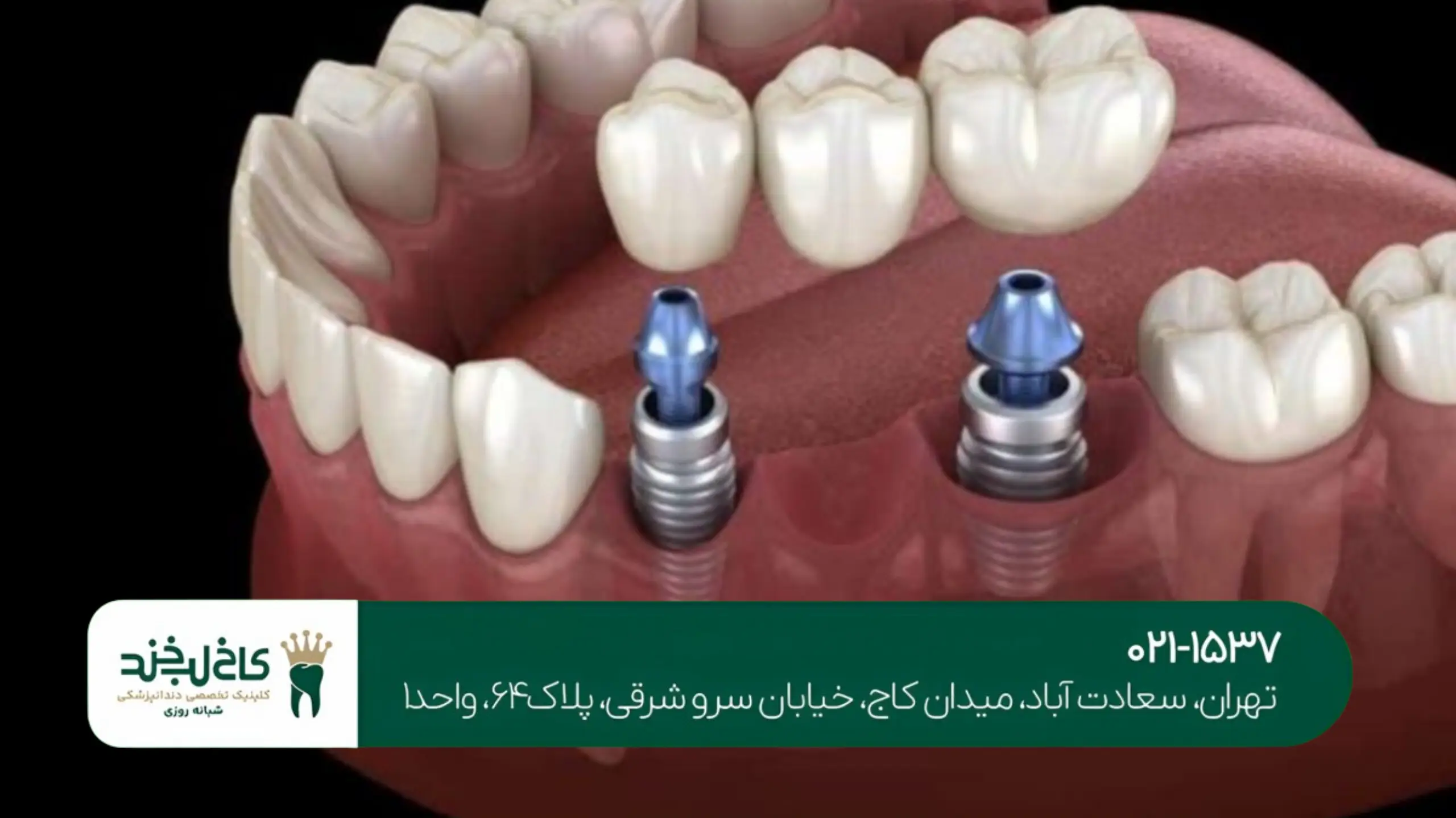 ایمپلنت اقساطی