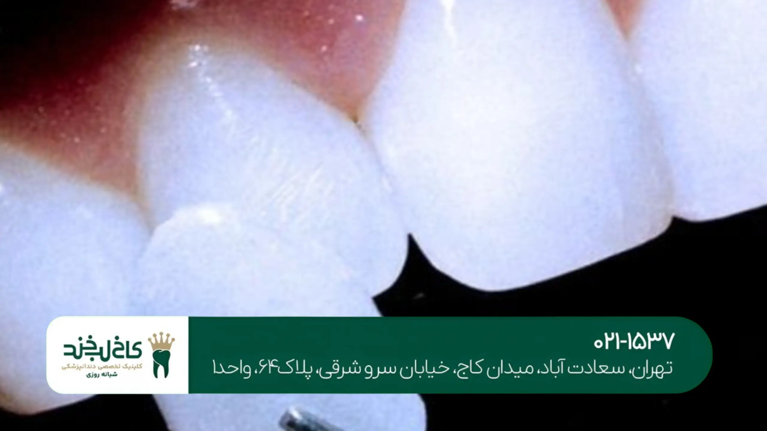 بهترین کلینیک لمینت