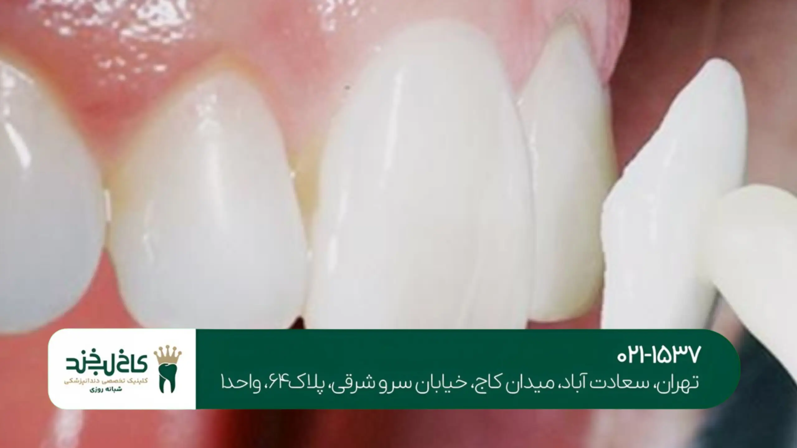 بهترین کلینیک لمینت