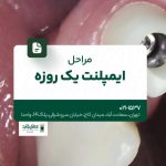 مراحل ایمپلنت یک روزه