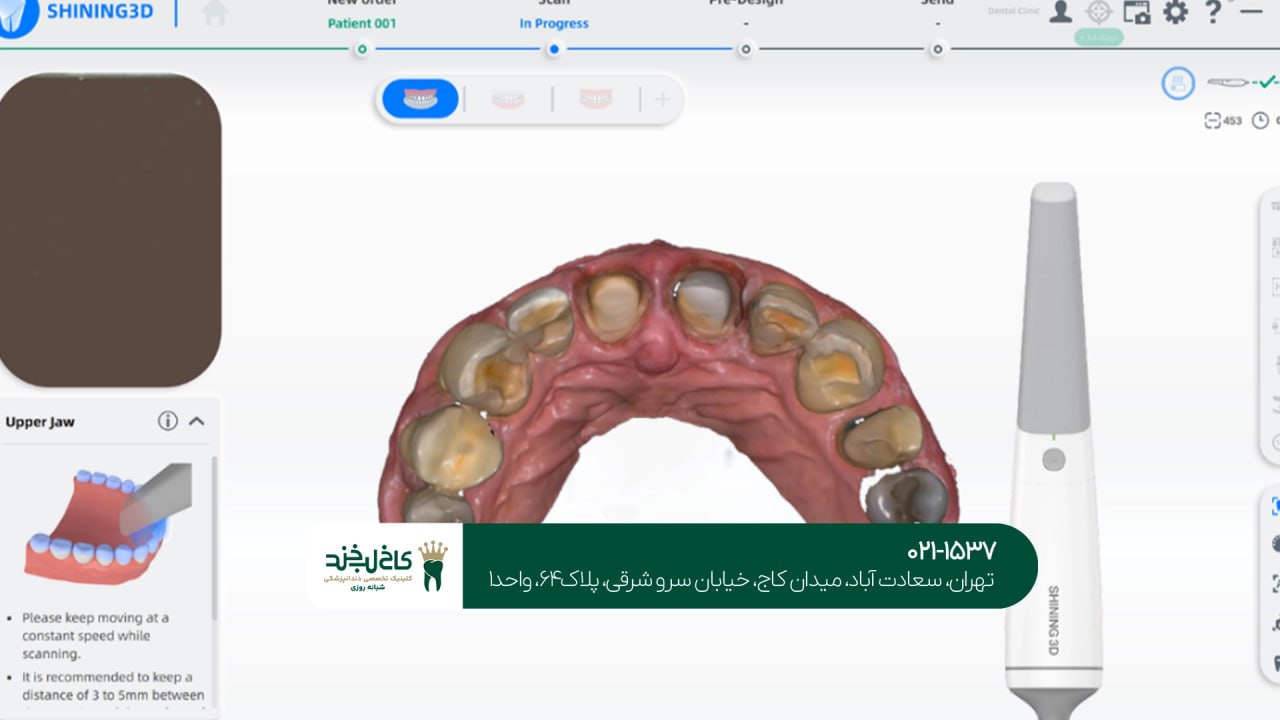 طراحی دیجیتال روکش دندان طراحی دیجیتال روکش دندان