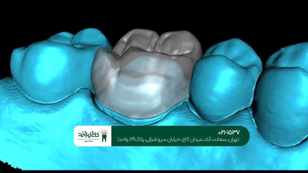 طراحی دیجیتال روکش دندان طراحی دیجیتال روکش دندان