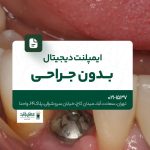 ایمپلنت دیجیتال بدون جراحی