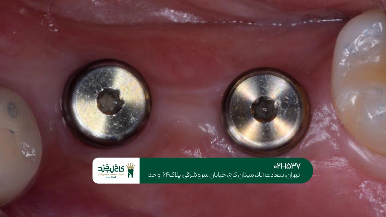 ایمپلنت دیجیتال بدون جراحی