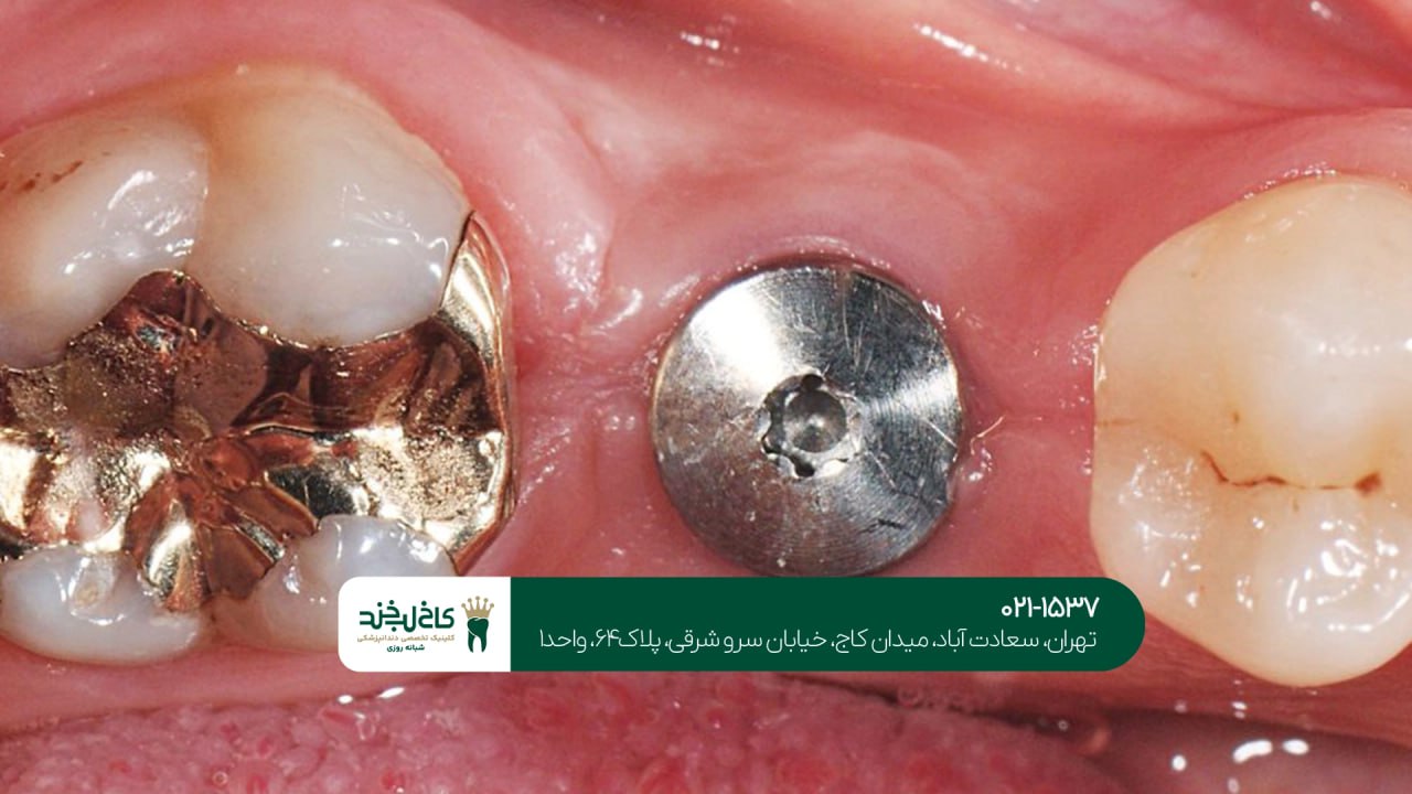 ایمپلنت دیجیتال بدون جراحی