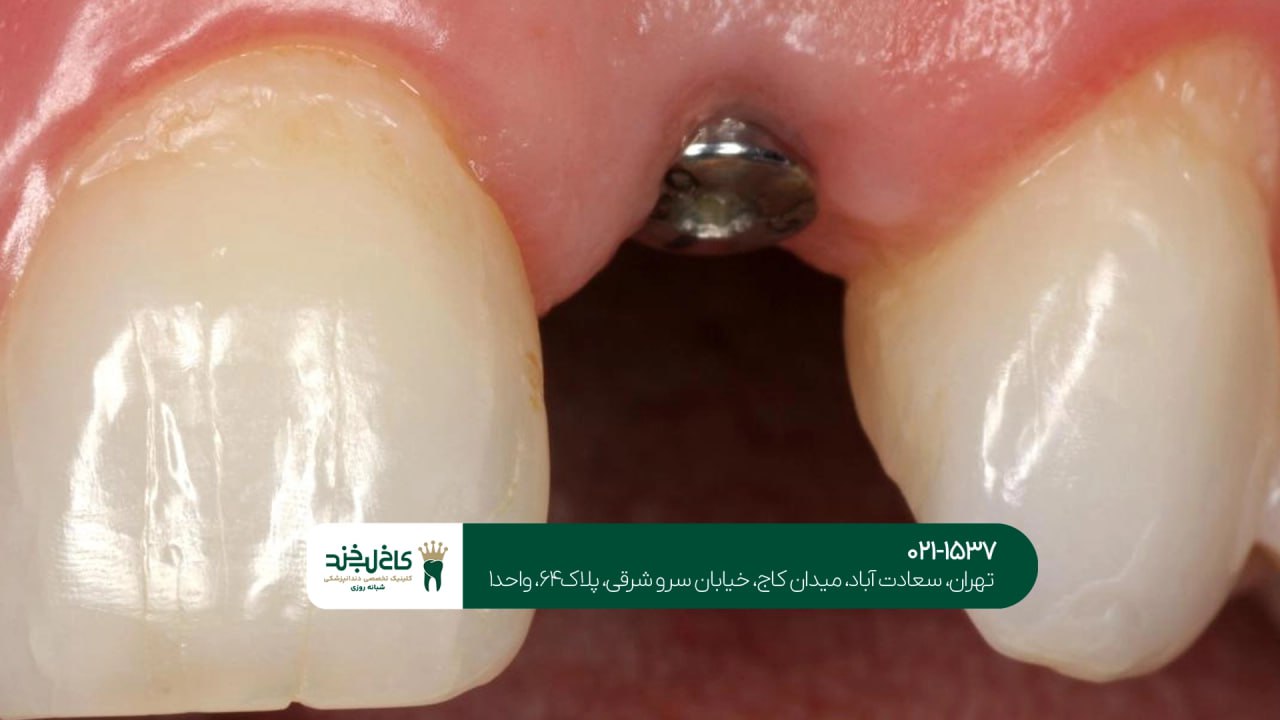 ایمپلنت دیجیتال بدون جراحی