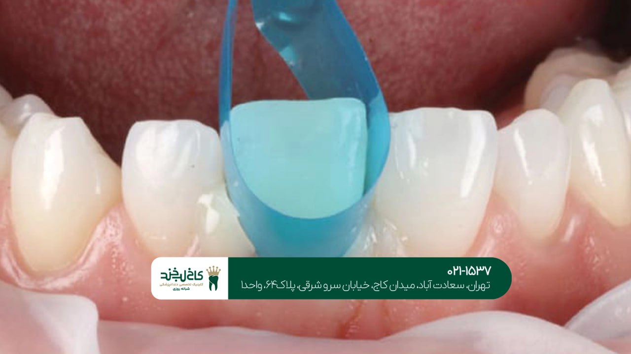 تمامی تفاوت های لمینت و کامپوزیت