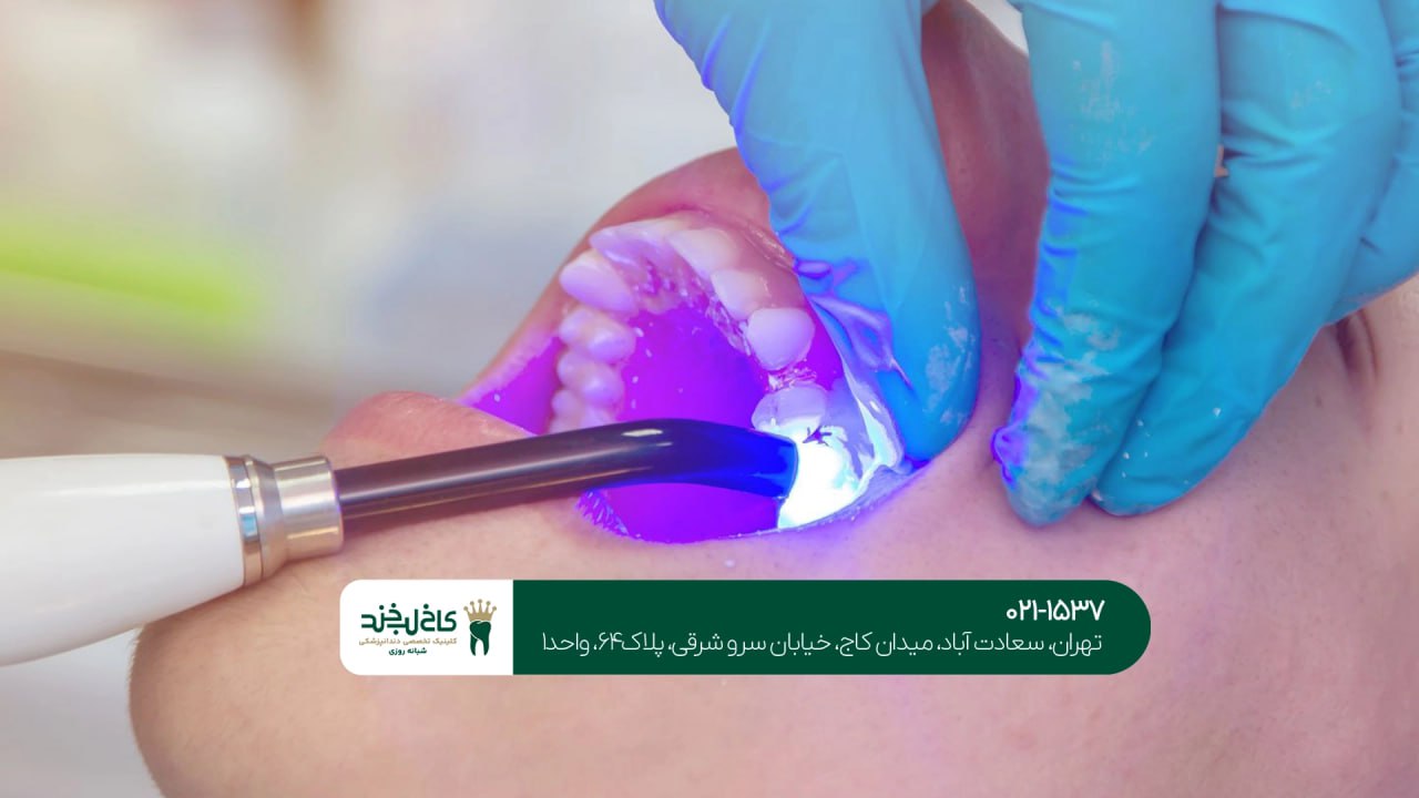 تمامی تفاوت های لمینت و کامپوزیت