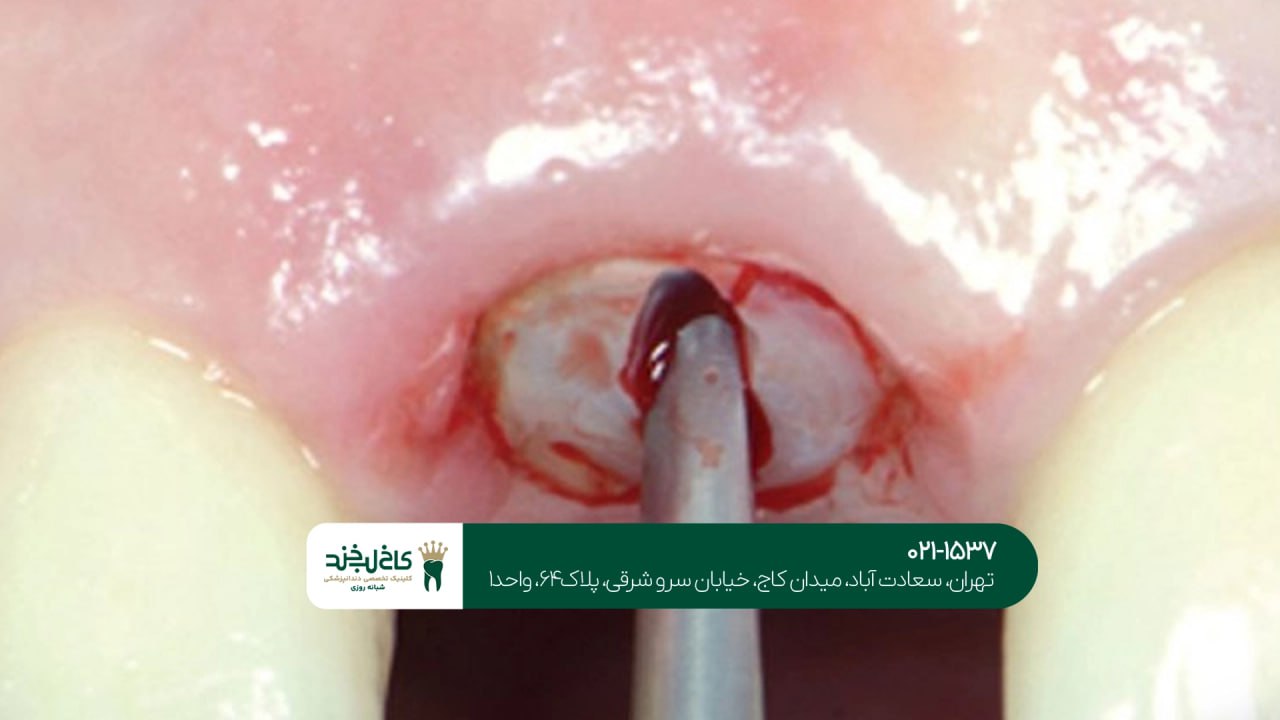 جراحی ریشه دندان تخصصی جراحی ریشه دندان تخصصی