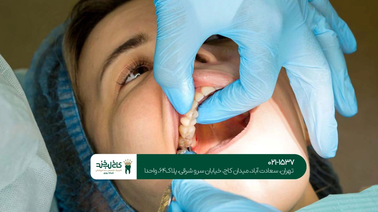 کشیدن دندان عقل بدون درد