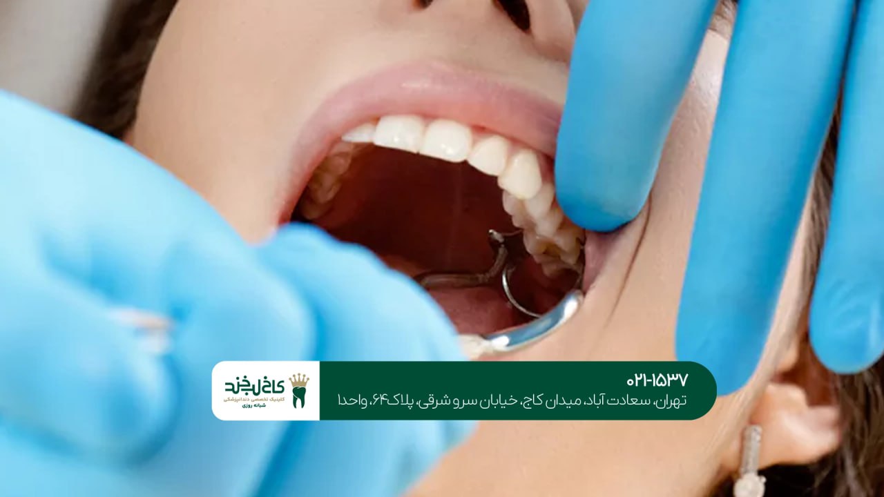 کشیدن دندان عقل بدون درد