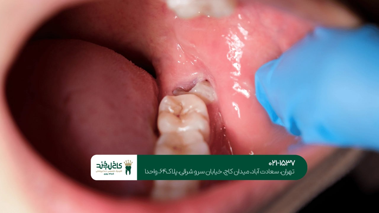 کشیدن دندان عقل بدون درد