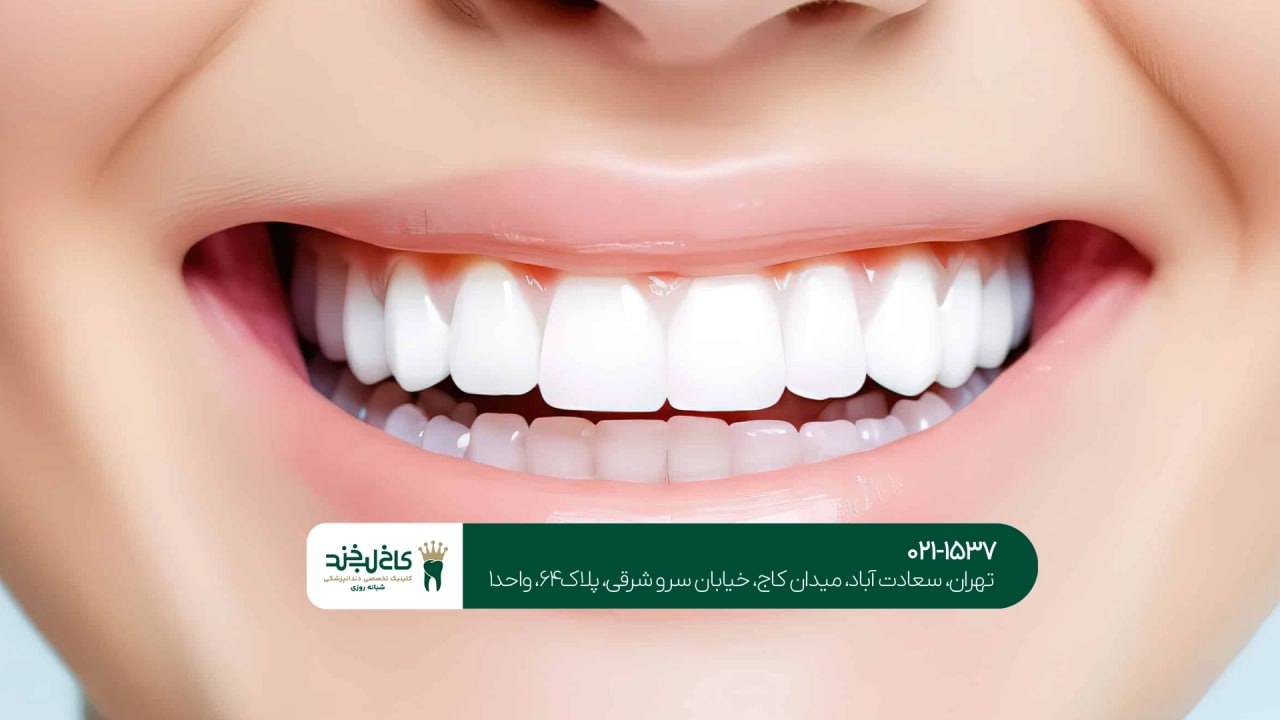 کامپوزیت اقساطی در شمال تهران کامپوزیت اقساطی در شمال تهران