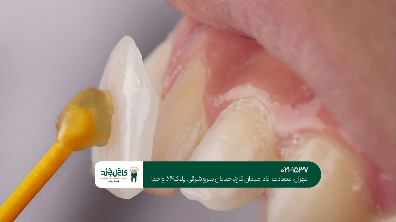 کلینیک لمینت اقساطی در تهران کلینیک لمینت اقساطی در تهران