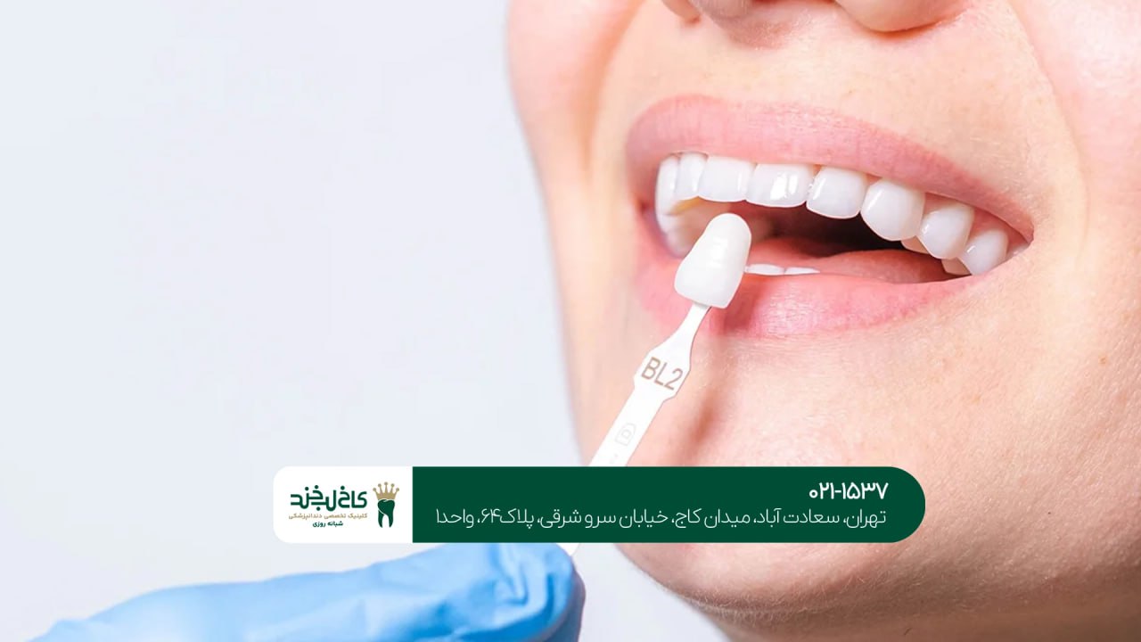 کلینیک لمینت اقساطی در تهران کلینیک لمینت اقساطی در تهران