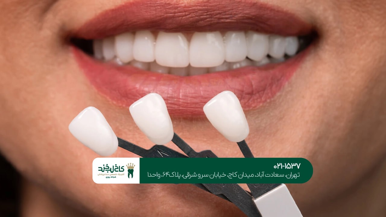 کلینیک لمینت اقساطی در تهران کلینیک لمینت اقساطی در تهران