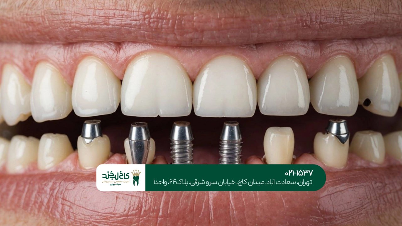 مرکز تخصصی ایمپلنت اقساطی