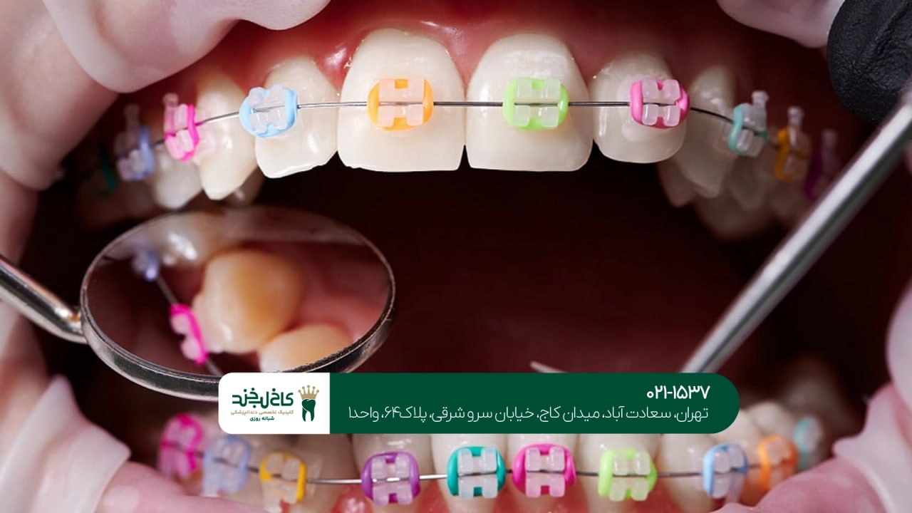 ارتودنسی اقساطی در تهران
