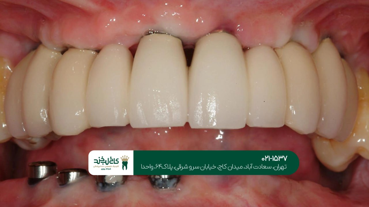 بهترین مرکز اقساطی ایمپلنت تهران