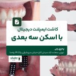 کاشت ایمپلنت دیجیتال با اسکن سه بعدی
