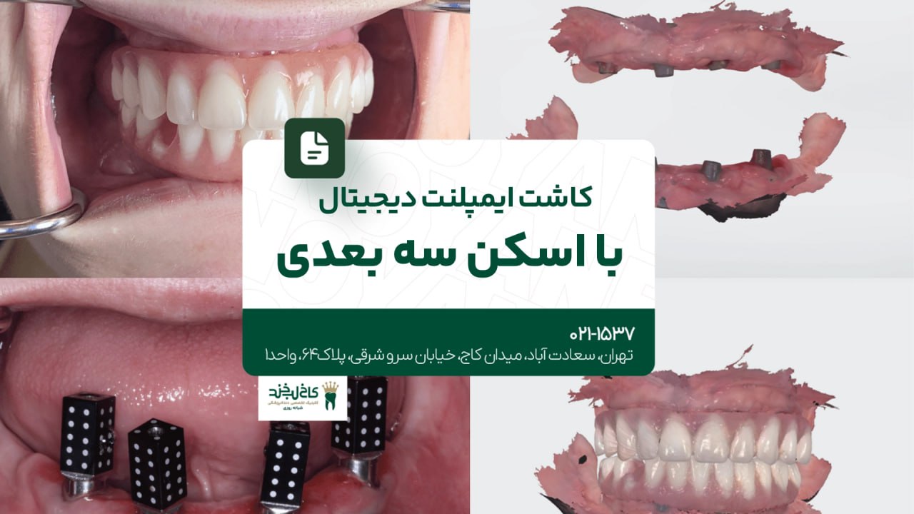 کاشت ایمپلنت دیجیتال با اسکن سه بعدی کاشت ایمپلنت دیجیتال با اسکن سه بعدی