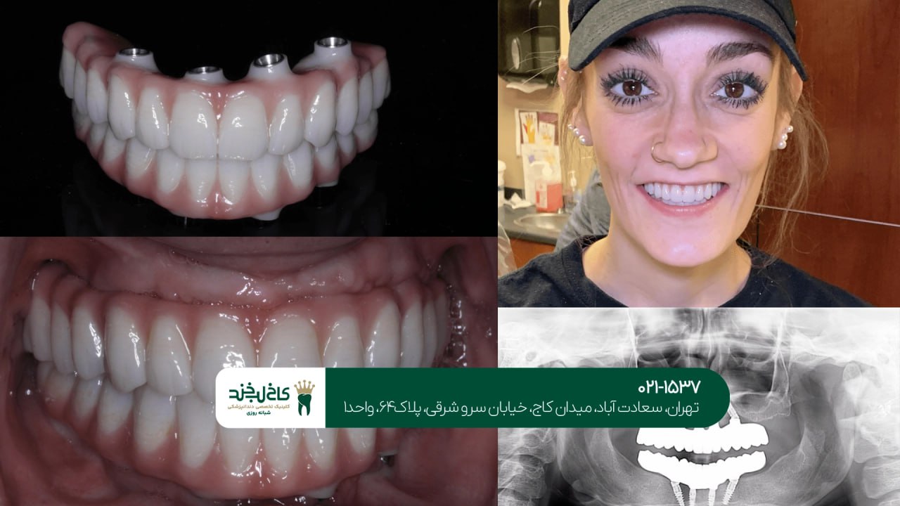 کاشت ایمپلنت دیجیتال با اسکن سه بعدی کاشت ایمپلنت دیجیتال با اسکن سه بعدی