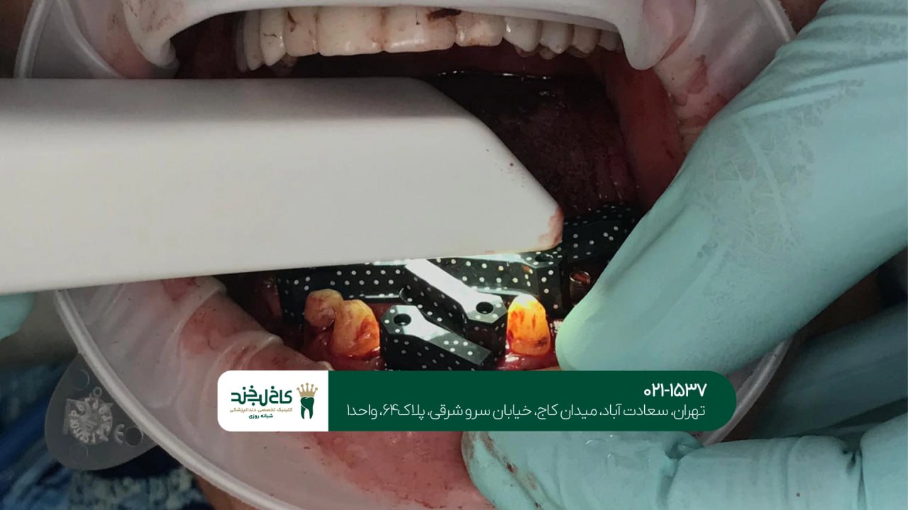 کاشت ایمپلنت دیجیتال با اسکن سه بعدی کاشت ایمپلنت دیجیتال با اسکن سه بعدی