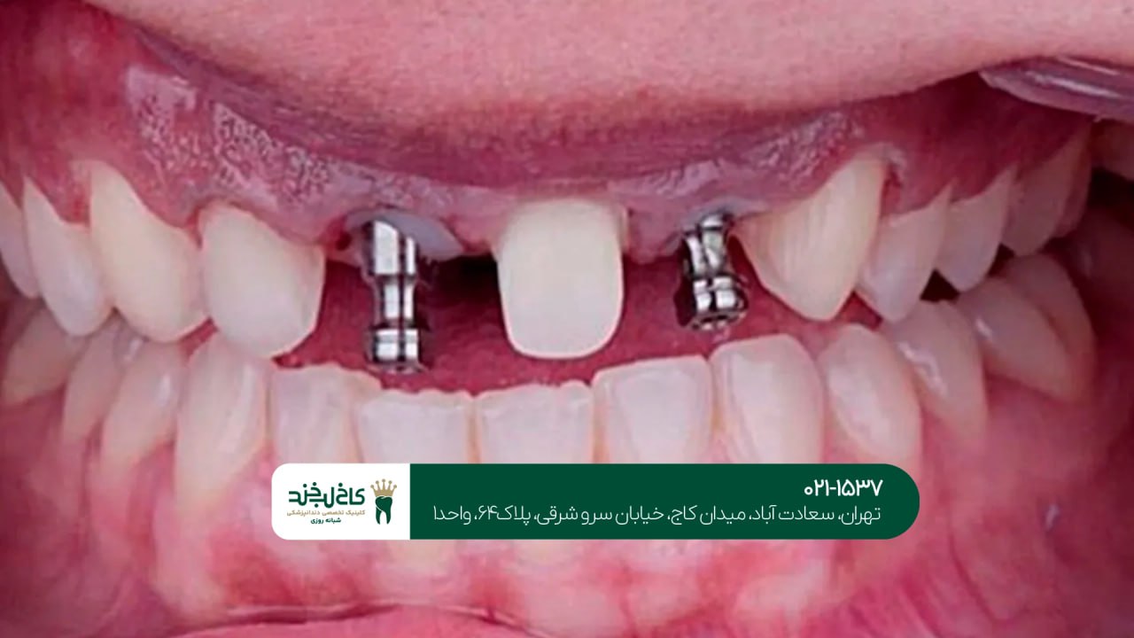 مرکز ایمپلنت اقساطی در تهران