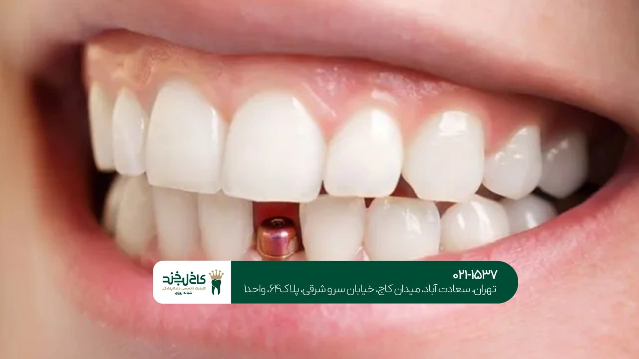 مرکز ایمپلنت اقساطی در تهران مرکز ایمپلنت اقساطی در تهران