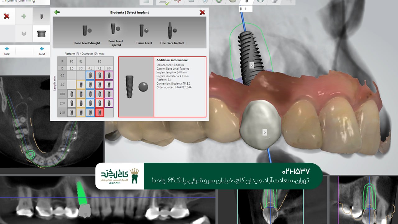 بهترین مرکز تخصصی ایمپلنت دیجیتال بهترین مرکز تخصصی ایمپلنت دیجیتال