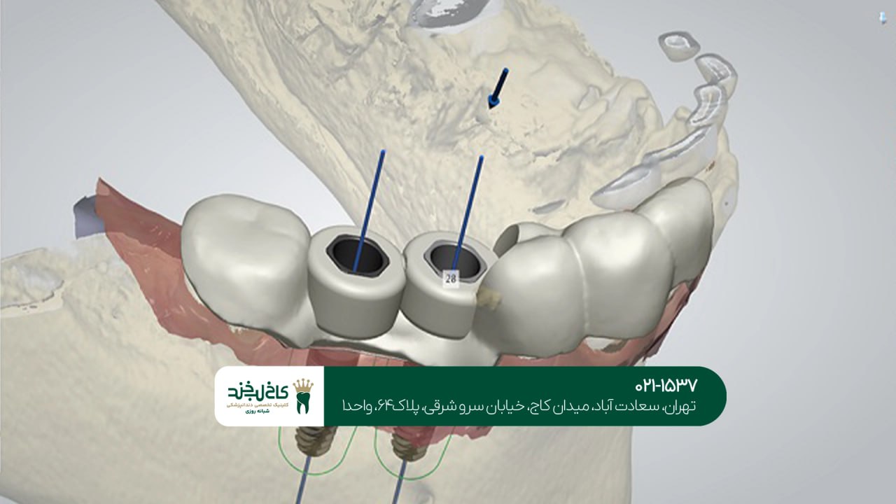 بهترین مرکز تخصصی ایمپلنت دیجیتال بهترین مرکز تخصصی ایمپلنت دیجیتال