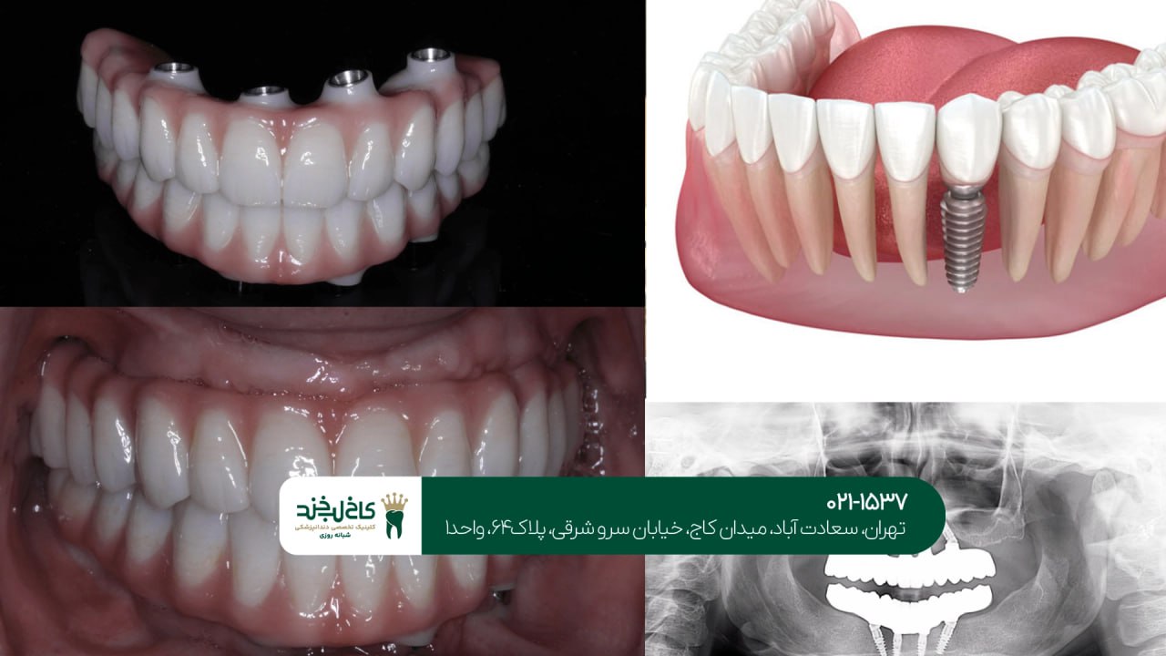 کاشت ایمپلنت دیجیتال با اسکن سه بعدی کاشت ایمپلنت دیجیتال با اسکن سه بعدی
