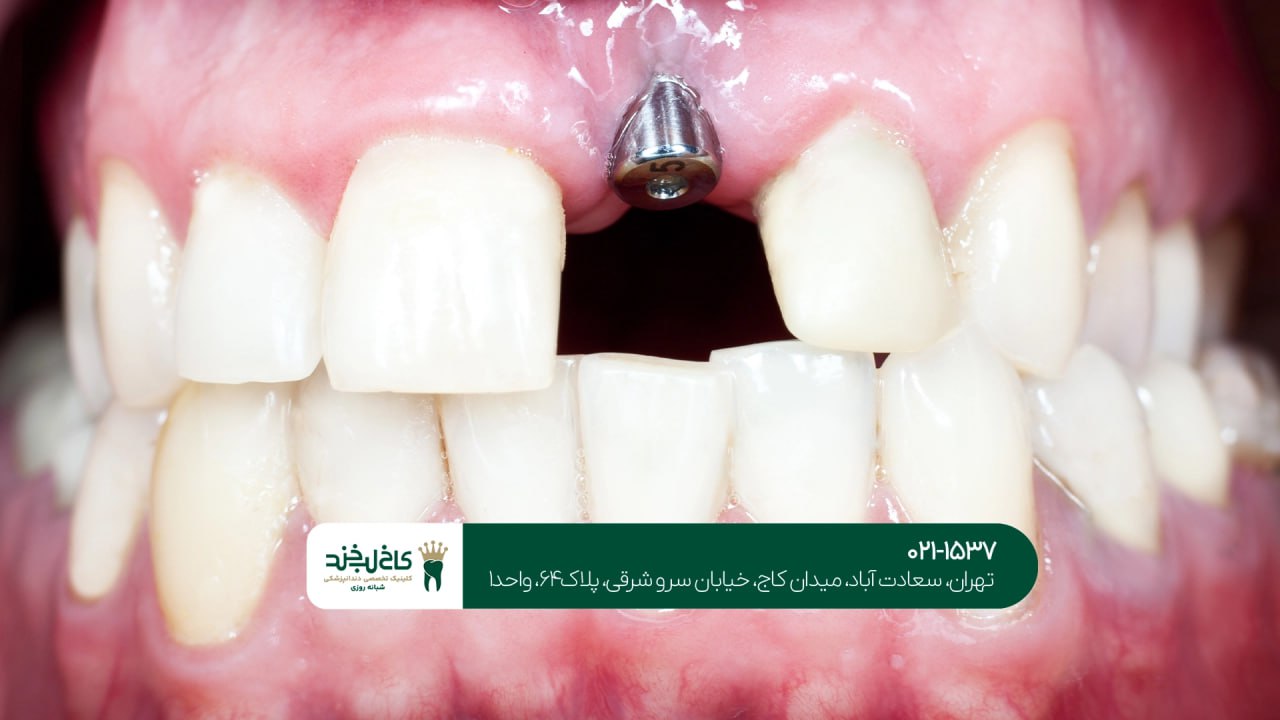 کاشت دندان دیجیتال اقساطی کاشت دندان دیجیتال اقساطی