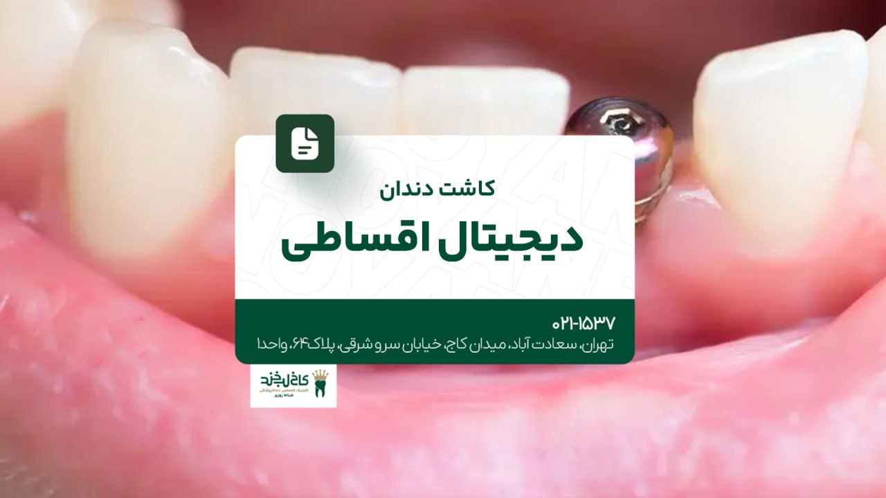 کاشت دندان دیجیتال اقساطی کاشت دندان دیجیتال اقساطی