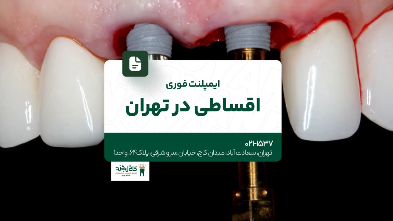 ایمپلنت فوری اقساطی در تهران ایمپلنت فوری اقساطی در تهران