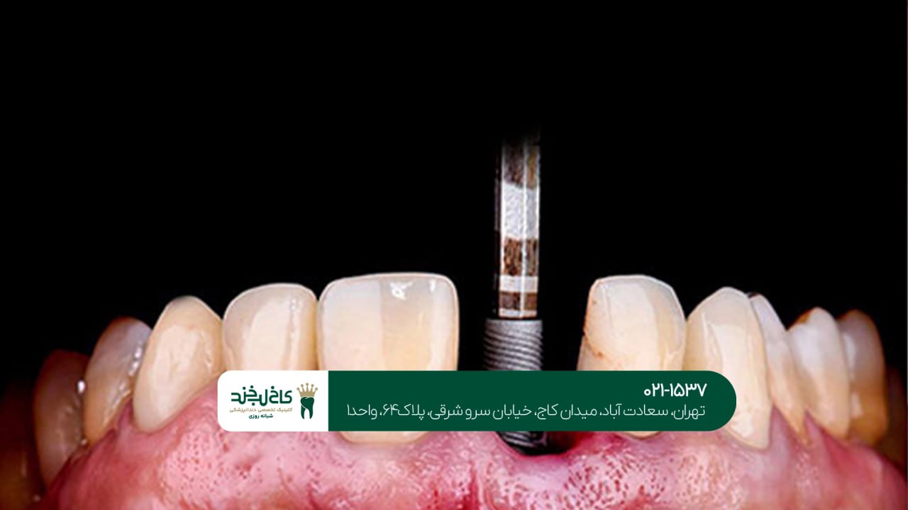 ایمپلنت فوری اقساطی در تهران ایمپلنت فوری اقساطی در تهران