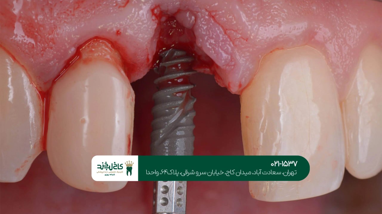 ایمپلنت فوری اقساطی در تهران ایمپلنت فوری اقساطی در تهران