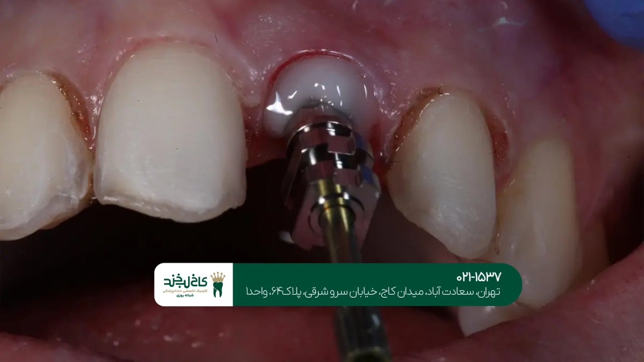 ایمپلنت فوری اقساطی در تهران ایمپلنت فوری اقساطی در تهران