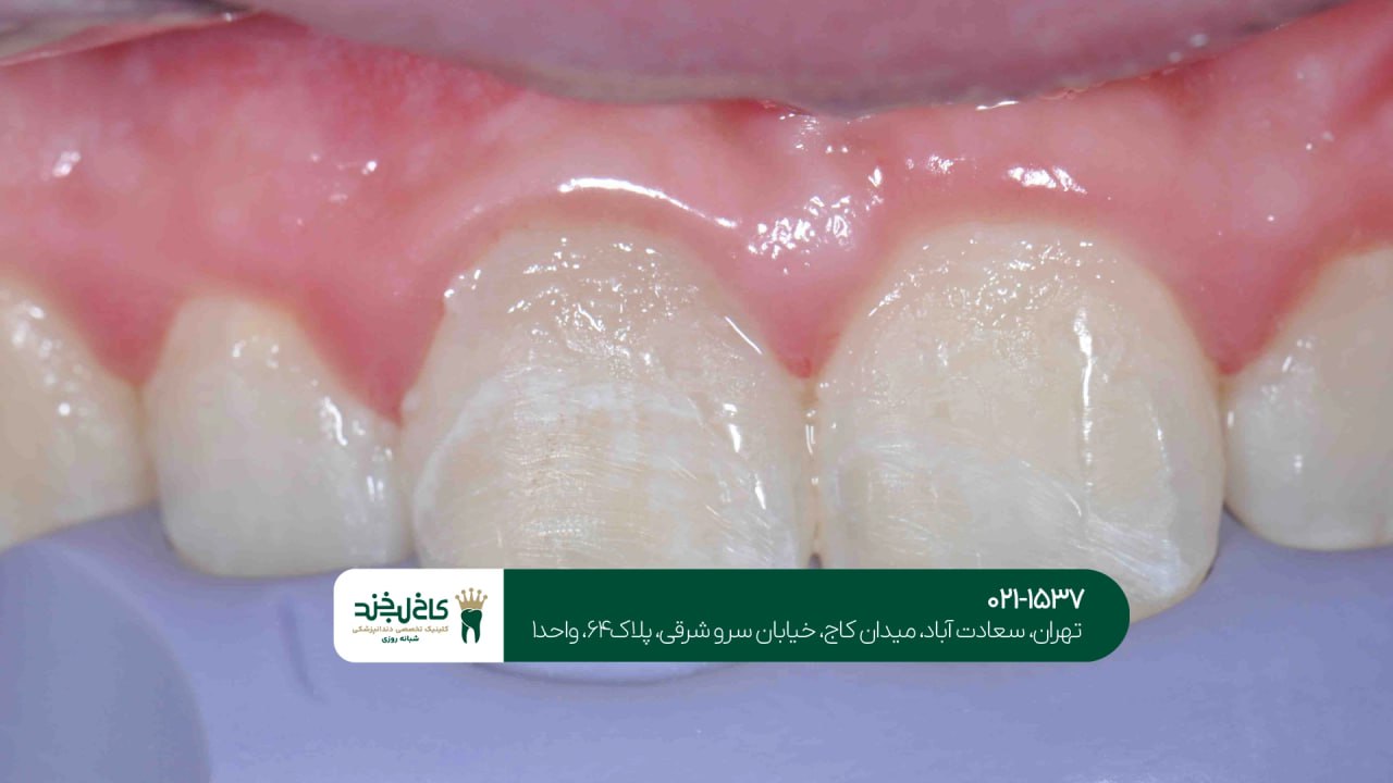 ترمیم دندان شکسته اقساطی ترمیم دندان شکسته اقساطی